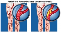 How Peripheral Arterial Disease Affects the Feet