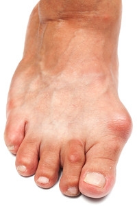 Determining Whether You Need Surgery to Treat Your Bunions