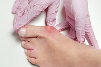 Understanding Bunions and When Surgery May Be Needed