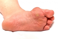 How Does a Bunion Form?