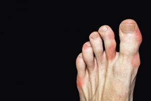Obesity and Gout
