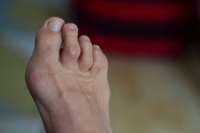 Symptoms and Treatment of Hammertoes