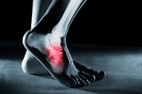 Midfoot Pain Can Be Caused by Arthritis