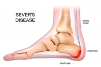What Causes Sever’s Disease?