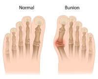 Understanding the Origins and Telltale Signs of a Bunion