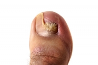 Why Are My Toenails So Thick?