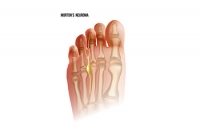 What Is Morton’s Neuroma?