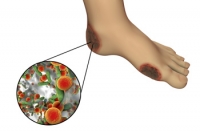 Plantar Warts are Caused By A Virus